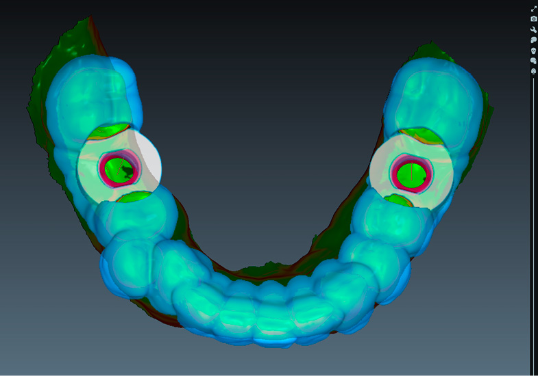 romexis-3d-implant-workflow-4.jpg