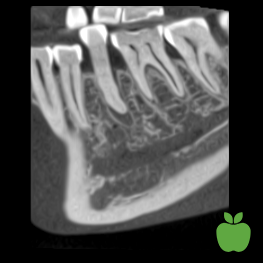 inormal resolution image with ultra low dose