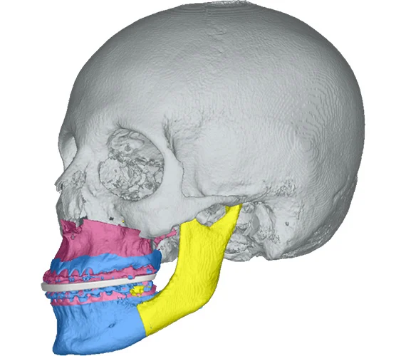 Planning orthognathic surgical treatments